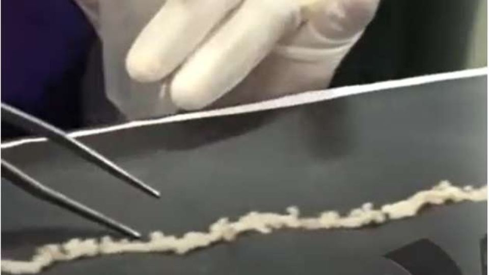 Dhuniyeyge emme dhigu tapeworm Lanka kuhjehgge hashigandun fenihjje