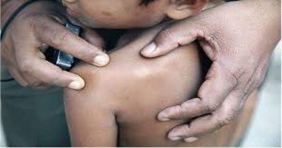 Lanka ge Moratuwa sarahadhugai Leprosy case thah ithurvanee
