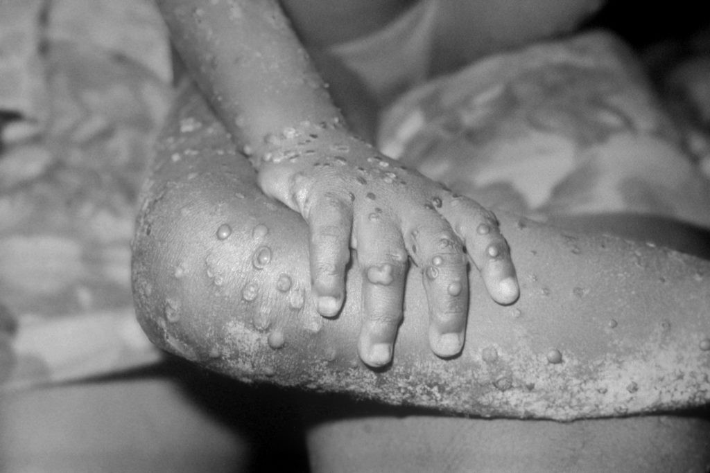 MPOX raajjeygai fethuridhaanethoa balanee