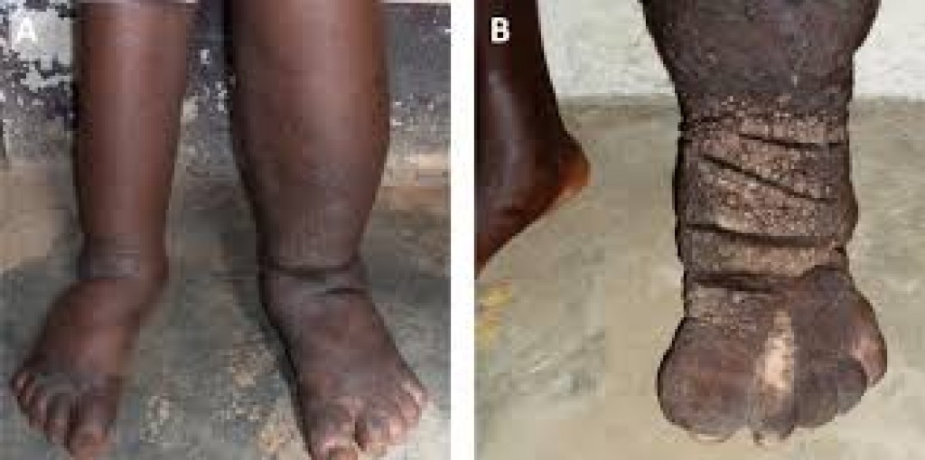 Kulhudhuifuishi city gai 25 bidheyseeaku filariasis ah positive, dhiveheen test kuranee