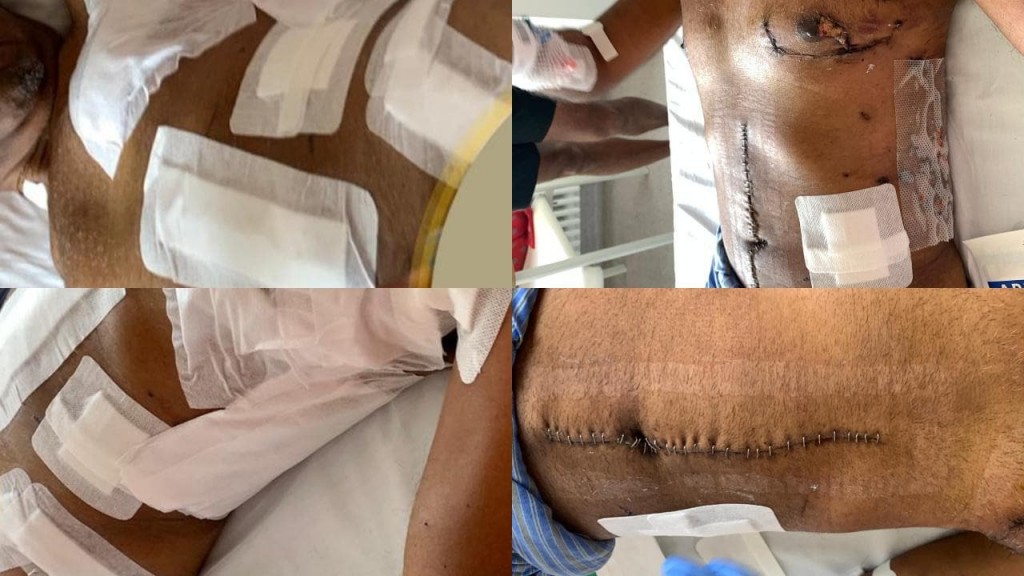 Photos of President Nasheed's injuries publicised