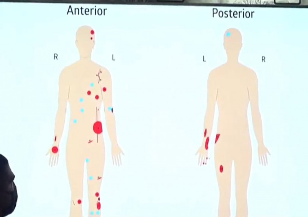 Projectiles from blast pierced Nasheed's intestine: ADK Hospital