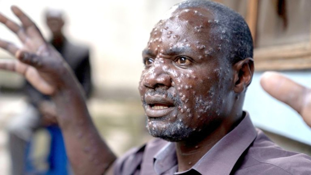Africa fiyavaa Mpox fenunu furathama gaumakah Sweden