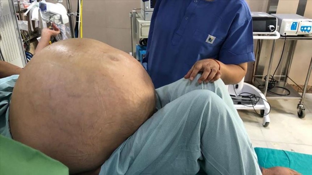 India gai 52 aharuge anhenehgge bandun 54 kg ge tumor eh nagaifi, miee record eh!