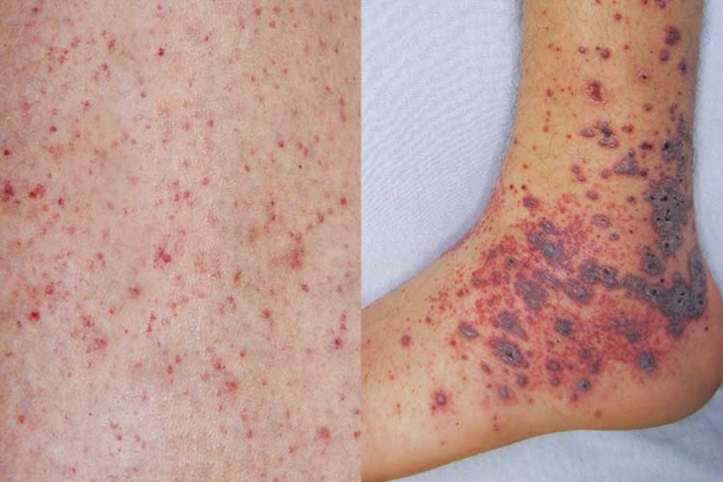 Contact in ah beysdhee Meningococcal ge contact tracing nimmaalaifi, ithuru case eh neiy