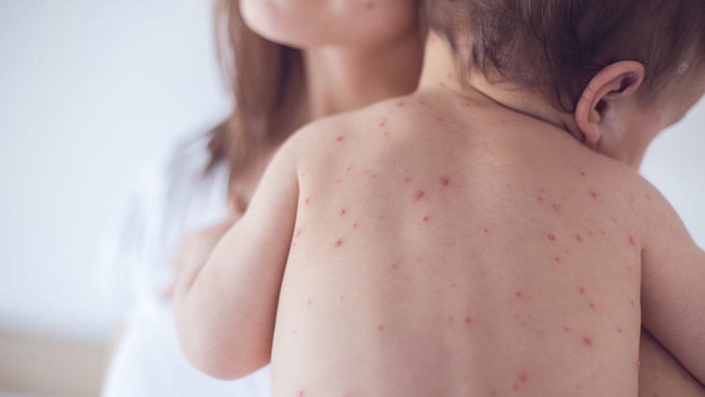 Another person confirmed to have Measles