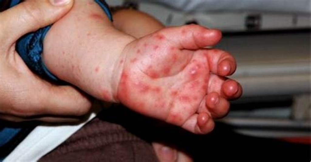 Faanabasandhaai Hand foot and mouth bali ithuruvanee