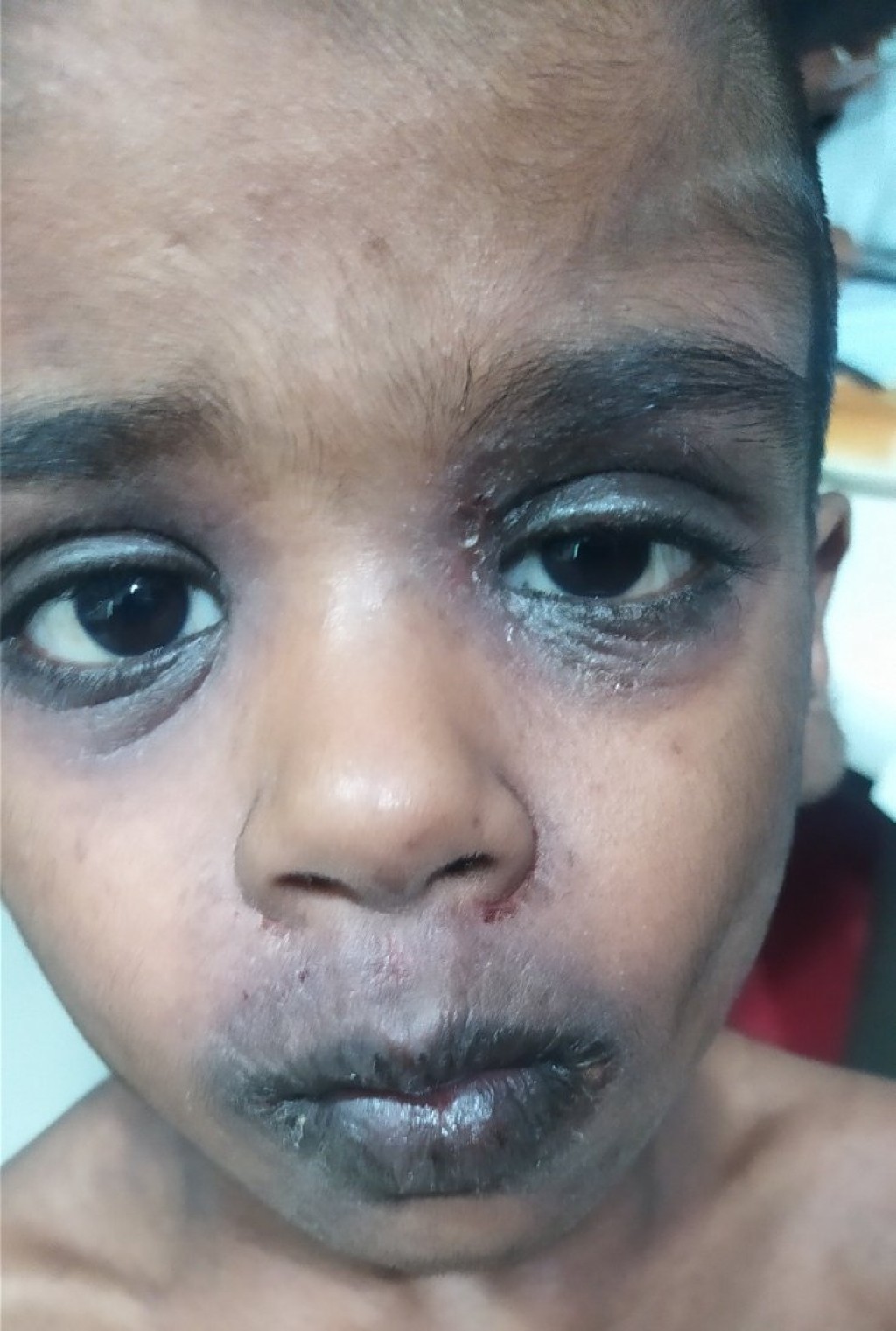 Umurun enme 5 aharu, allergy ehgge sababun nidhin mahroomve kiyevumahvves huraselhifai