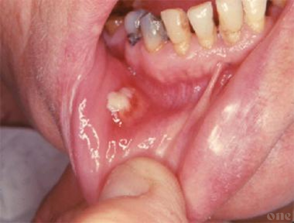 Most frequent cancers in Maldives is mouth and stomach cancer