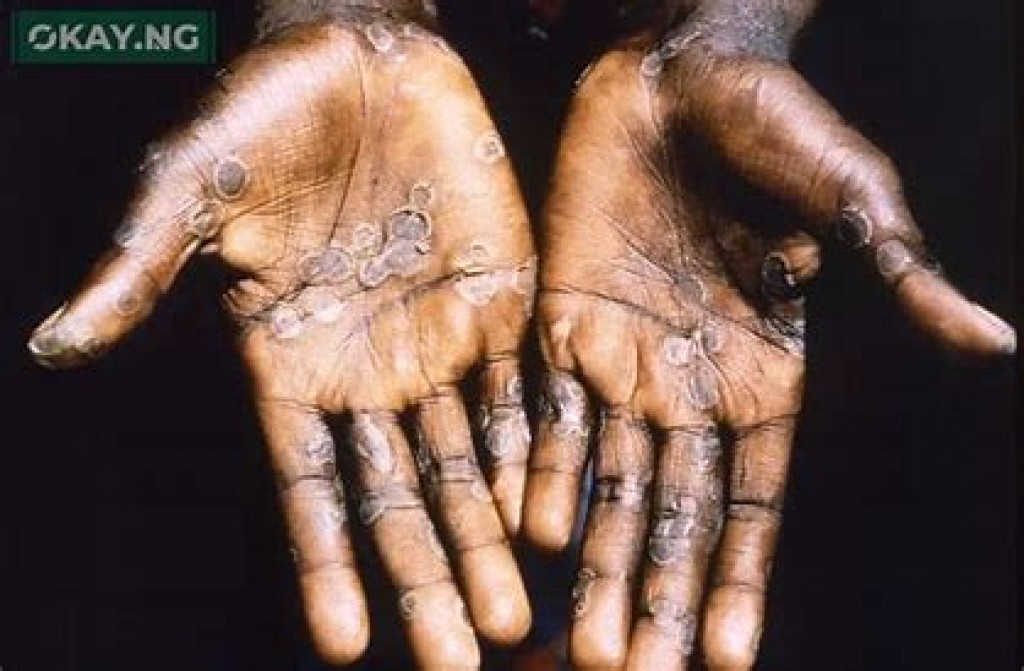 Mpox ge nurahkkaatheri case eh UK in fenihjje
