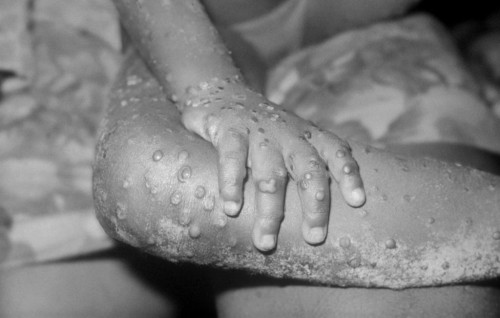MPOX raajjeygai fethuridhaanethoa balanee
