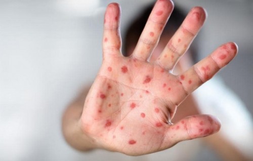 Measles vaccination campaign to be held in three atolls next week