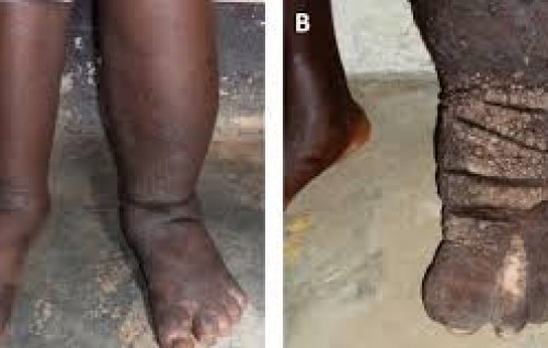 Kulhudhuifuishi city gai 25 bidheyseeaku filariasis ah positive, dhiveheen test kuranee