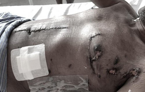 Raees Nasheed ge faige ithuru surgery eh kohfi