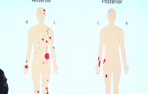 Projectiles from blast pierced Nasheed's intestine: ADK Hospital