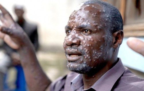 Africa fiyavaa Mpox fenunu furathama gaumakah Sweden
