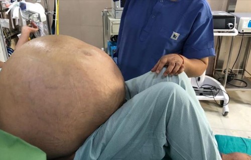 India gai 52 aharuge anhenehgge bandun 54 kg ge tumor eh nagaifi, miee record eh!