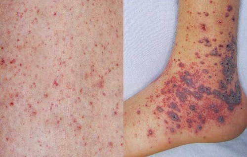 Contact in ah beysdhee Meningococcal ge contact tracing nimmaalaifi, ithuru case eh neiy