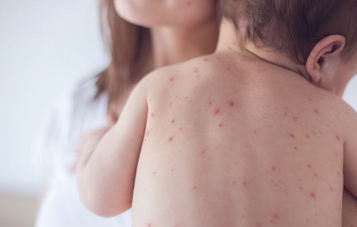 Another person confirmed to have Measles