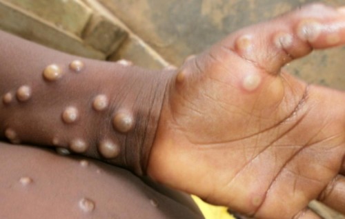 Monkeypox aky kobaa?