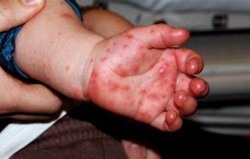 Faanabasandhaai Hand foot and mouth bali ithuruvanee