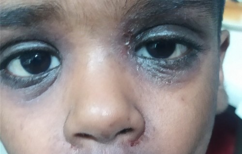 Umurun enme 5 aharu, allergy ehgge sababun nidhin mahroomve kiyevumahvves huraselhifai
