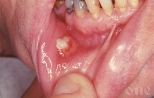 Most frequent cancers in Maldives is mouth and stomach cancer