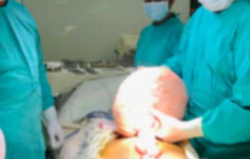 Lanka gai meehehgge rahimun 10 kilo ge tumor eh nagaifi