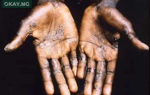 Mpox ge nurahkkaatheri case eh UK in fenihjje